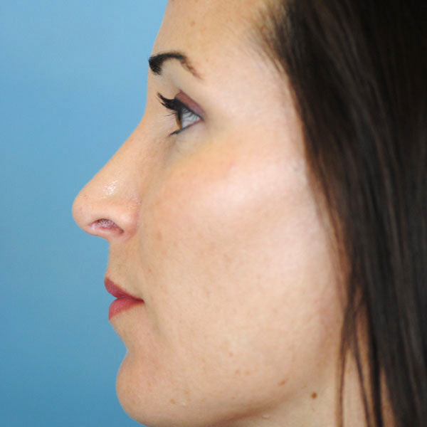 Rhinoplasty Before and After | Thomas Funcik MD