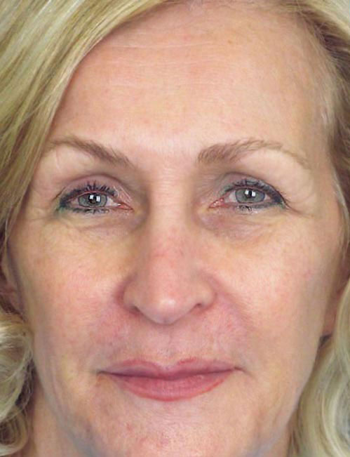 Rhinoplasty Before and After | Thomas Funcik MD