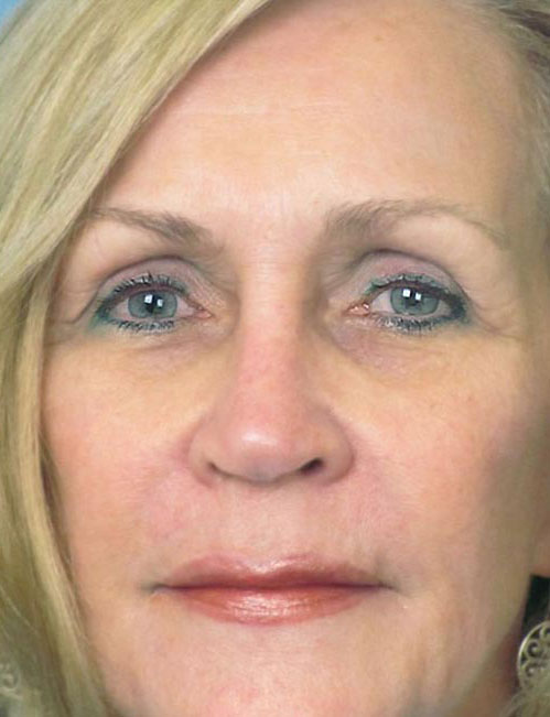 Rhinoplasty Before and After | Thomas Funcik MD