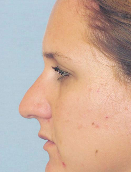 Rhinoplasty Before and After | Thomas Funcik MD