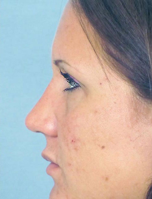 Rhinoplasty Before and After | Thomas Funcik MD