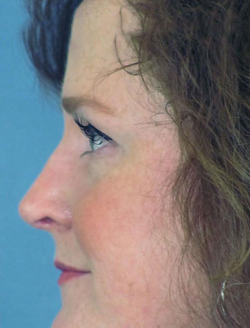 Rhinoplasty Before and After | Thomas Funcik MD