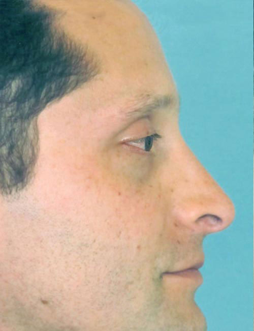 Rhinoplasty Before and After | Thomas Funcik MD