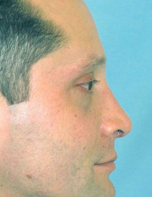 Rhinoplasty Before and After | Thomas Funcik MD