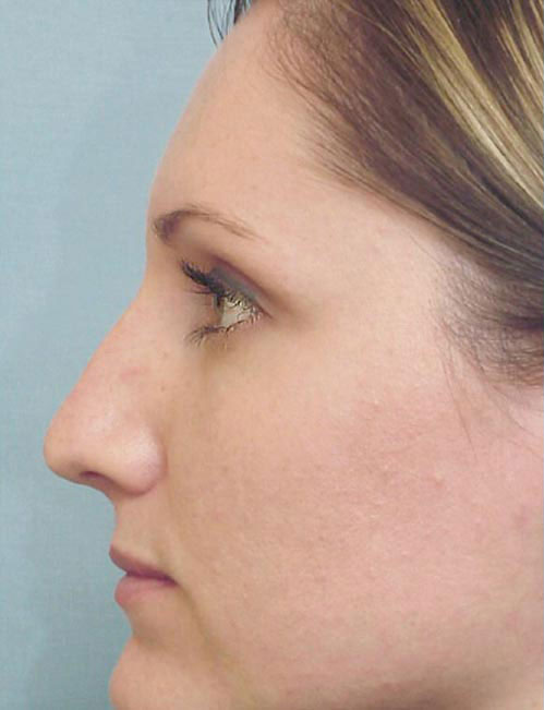 Rhinoplasty Before and After | Thomas Funcik MD