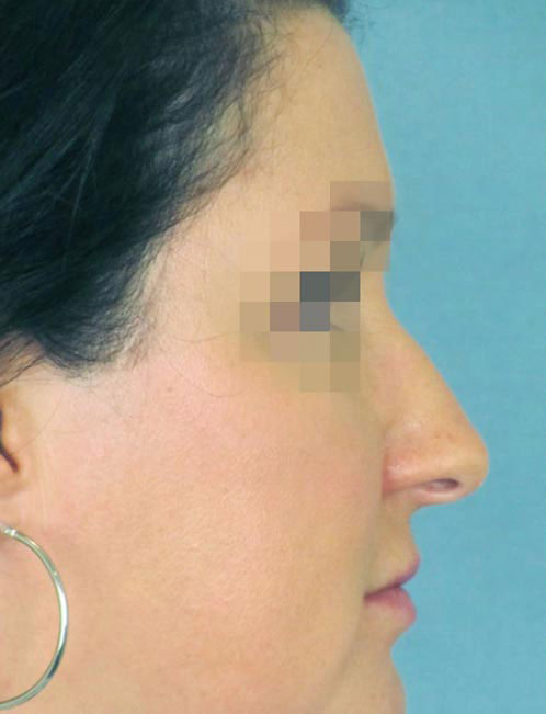 Rhinoplasty Before and After | Thomas Funcik MD