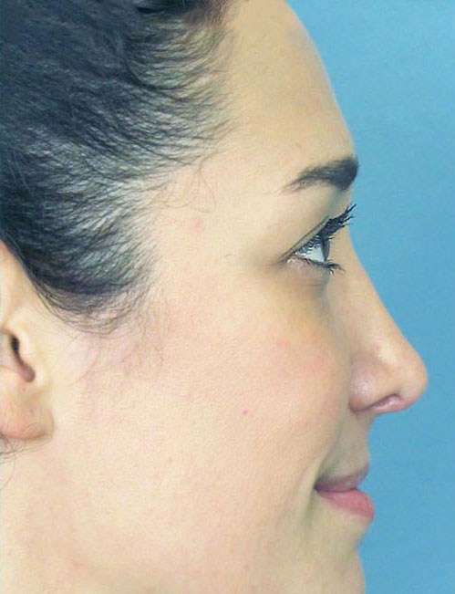 Rhinoplasty Before and After | Thomas Funcik MD