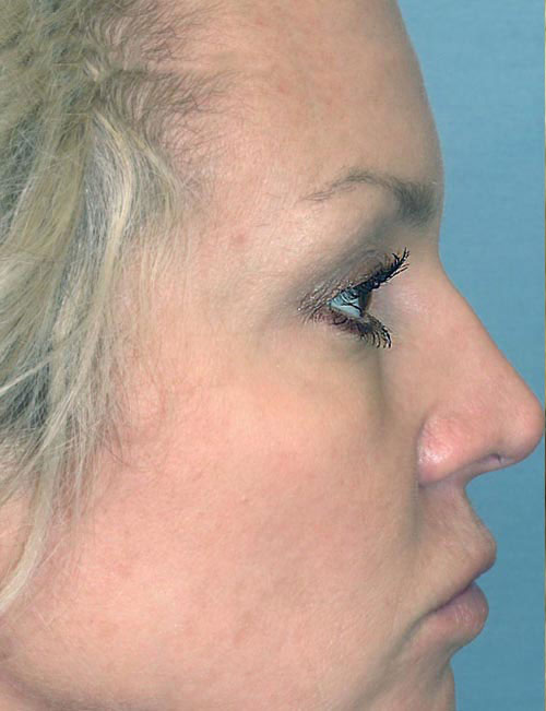 Rhinoplasty Before and After | Thomas Funcik MD