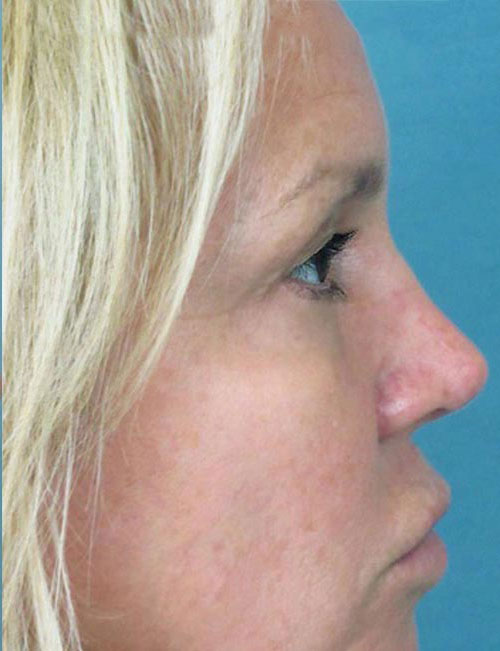 Rhinoplasty Before and After | Thomas Funcik MD