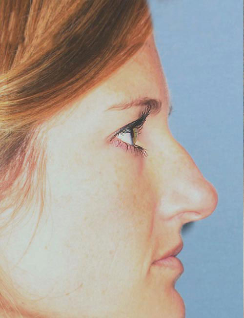 Rhinoplasty Before and After | Thomas Funcik MD