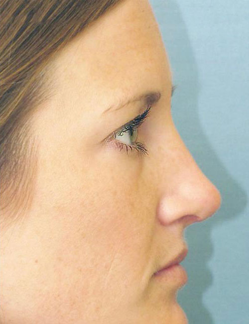 Rhinoplasty Before and After | Thomas Funcik MD