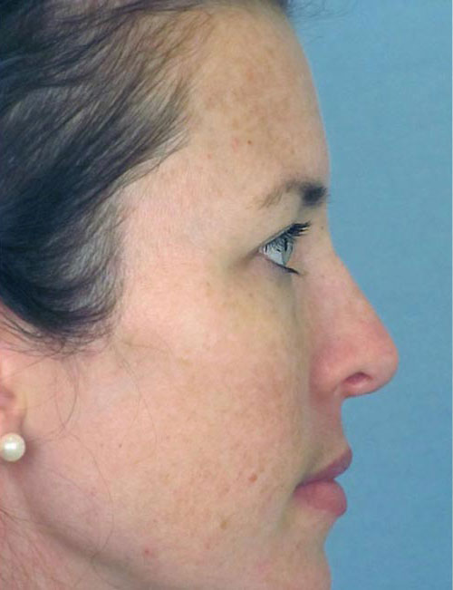 Rhinoplasty Before and After | Thomas Funcik MD