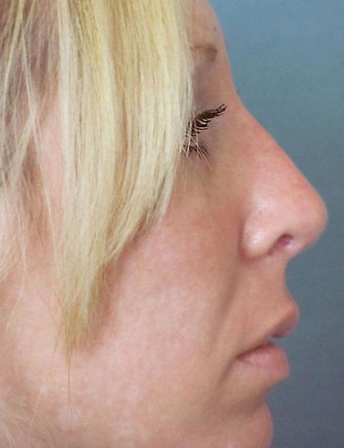 Rhinoplasty Before and After | Thomas Funcik MD