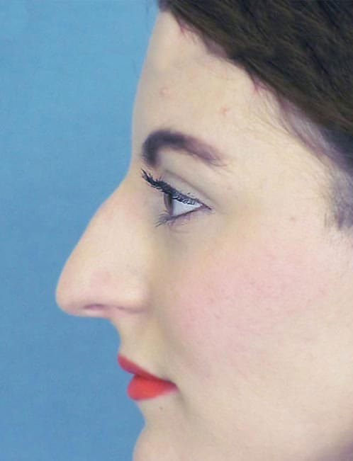 Rhinoplasty Before and After | Thomas Funcik MD