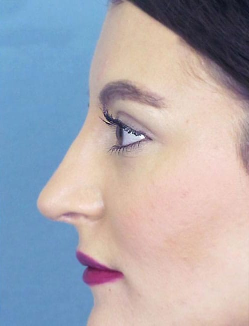 Rhinoplasty Before and After | Thomas Funcik MD