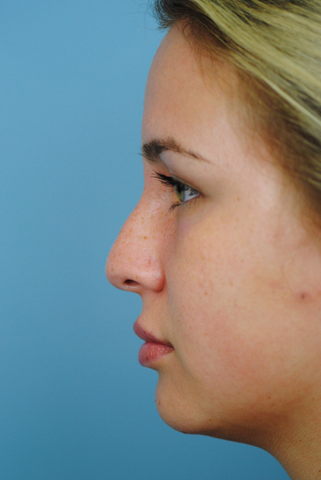 Rhinoplasty Before and After | Thomas Funcik MD