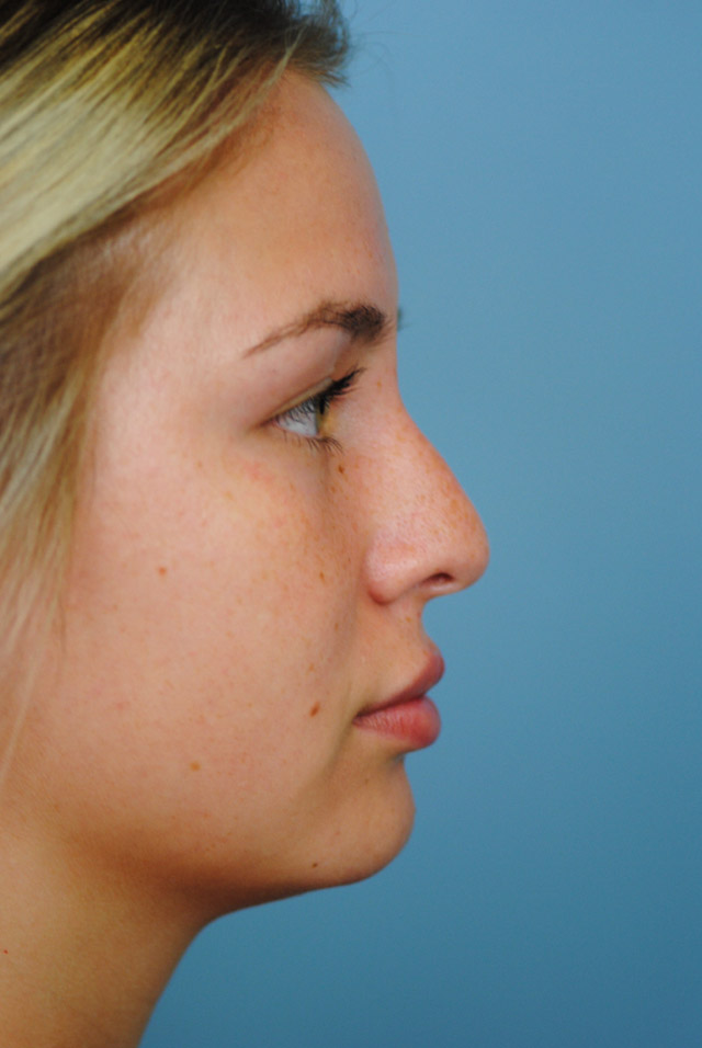 Rhinoplasty Before and After | Thomas Funcik MD