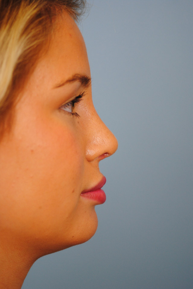 Rhinoplasty Before and After | Thomas Funcik MD