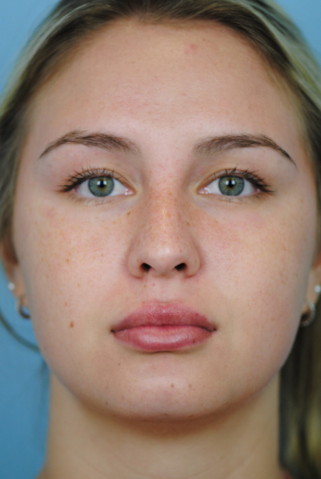 Rhinoplasty Before and After | Thomas Funcik MD