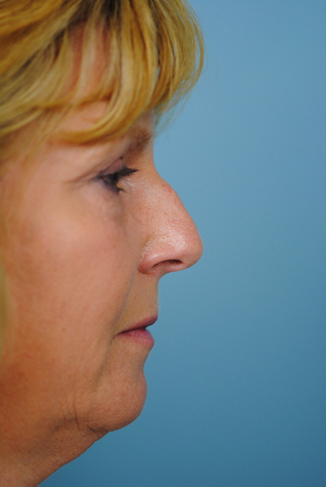 Rhinoplasty Before and After | Thomas Funcik MD