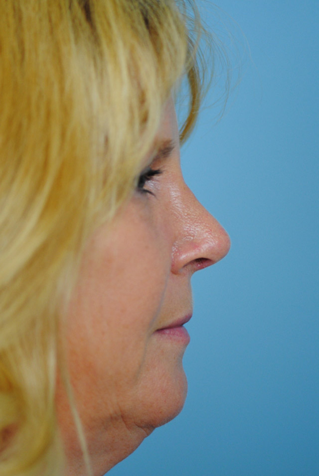 Rhinoplasty Before and After | Thomas Funcik MD