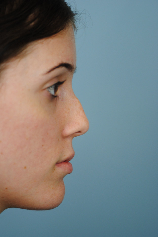 Rhinoplasty Before and After | Thomas Funcik MD