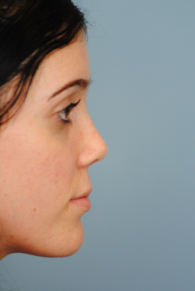 Rhinoplasty Before and After | Thomas Funcik MD