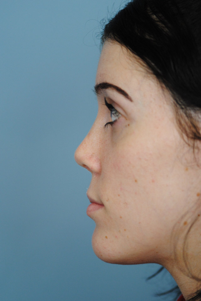 Rhinoplasty Before and After | Thomas Funcik MD