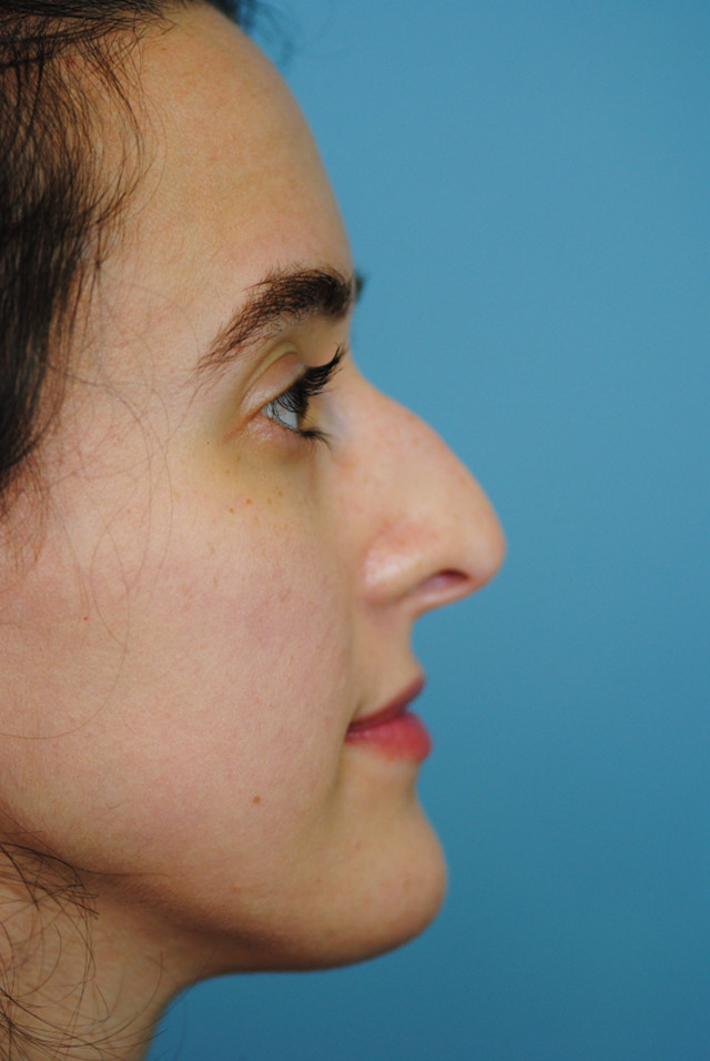 Rhinoplasty Before and After | Thomas Funcik MD