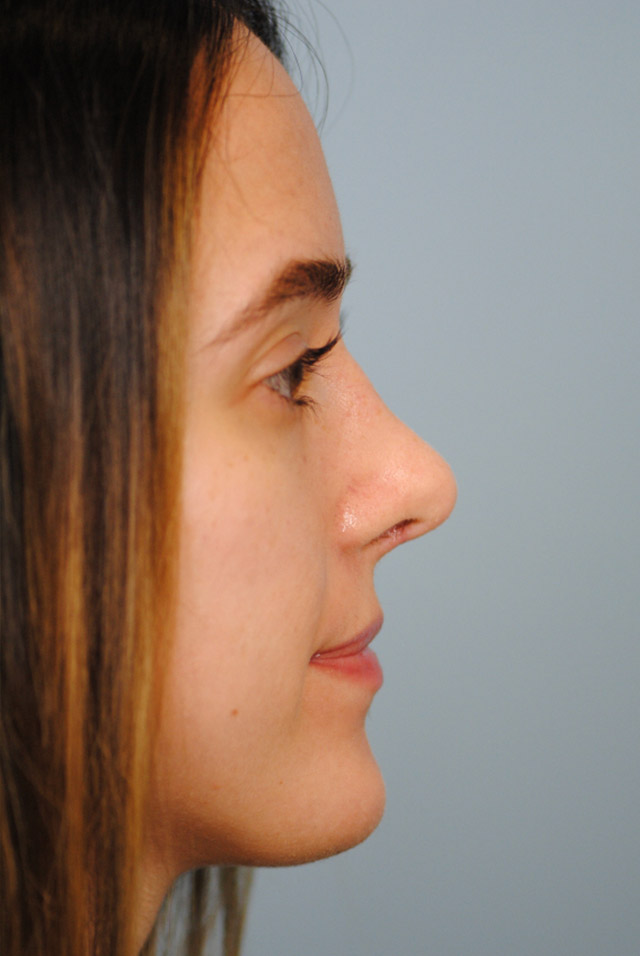 Rhinoplasty Before and After | Thomas Funcik MD