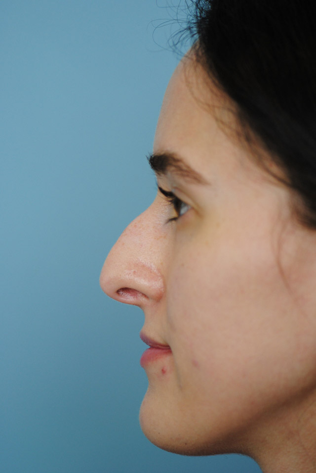 Rhinoplasty Before and After | Thomas Funcik MD