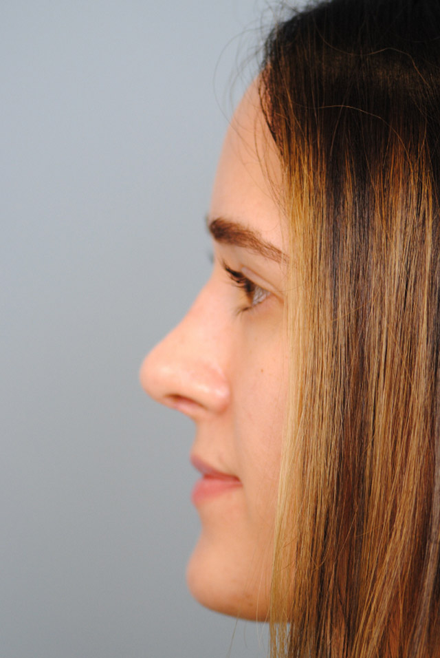 Rhinoplasty Before and After | Thomas Funcik MD