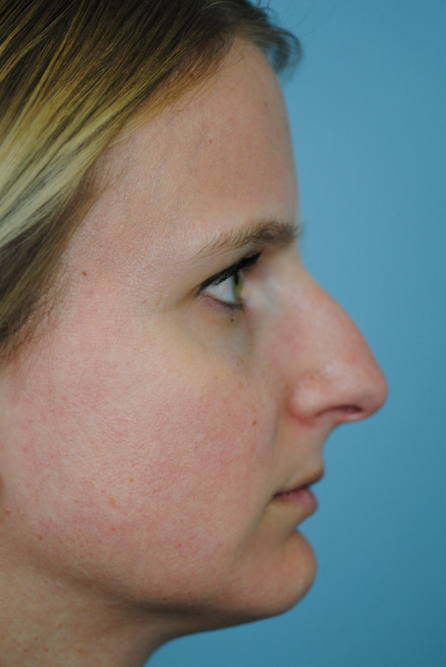 Rhinoplasty Before and After | Thomas Funcik MD