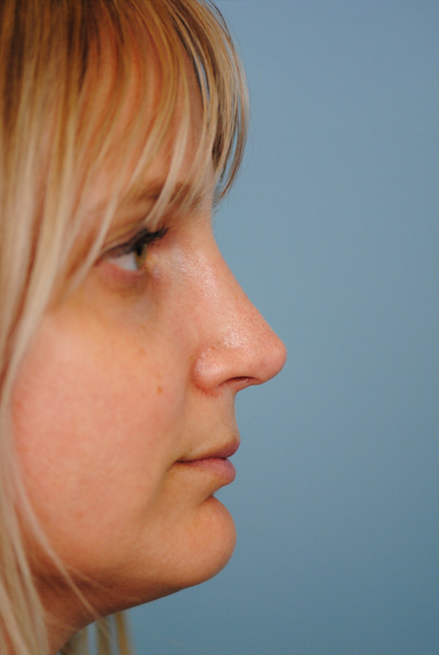 Rhinoplasty Before and After | Thomas Funcik MD