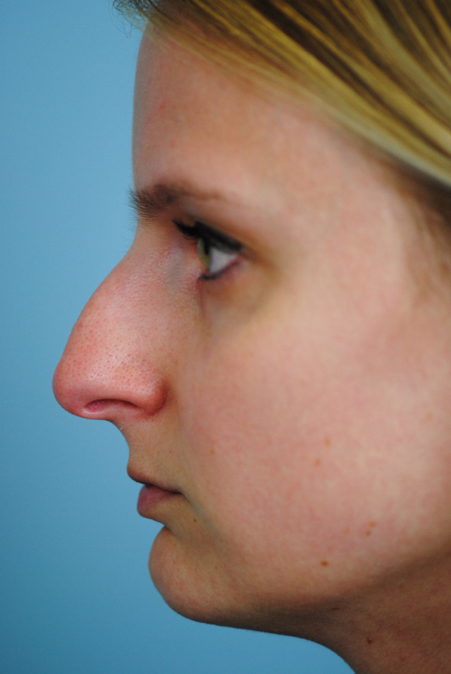 Rhinoplasty Before and After | Thomas Funcik MD