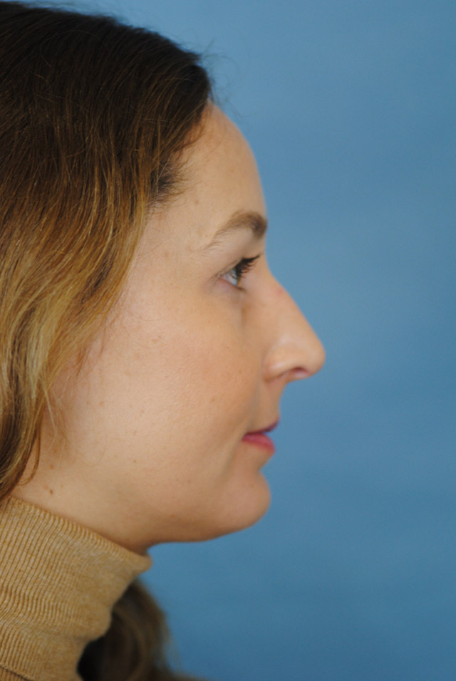 Rhinoplasty Before and After | Thomas Funcik MD