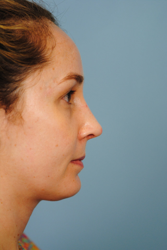 Rhinoplasty Before and After | Thomas Funcik MD