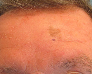 Skin Cancer Reconstruction Before and After | Thomas Funcik MD