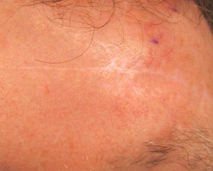 Skin Cancer Reconstruction Before and After | Thomas Funcik MD