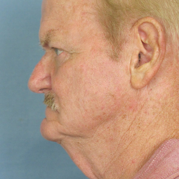 W Plasty Neck Lift Before and After | Thomas Funcik MD