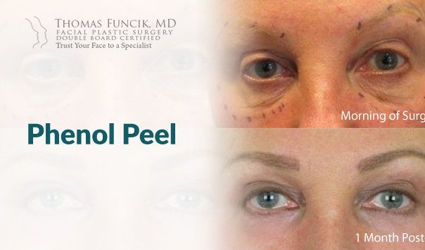 Phenol Peel image