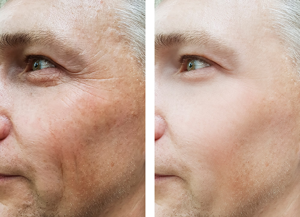 Cosmetic Procedures for Men