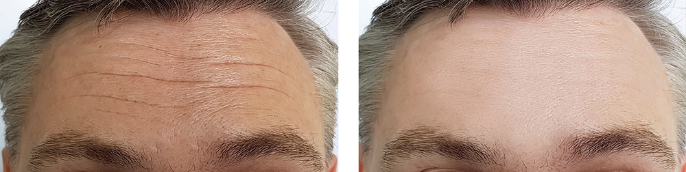 male forehead lift results