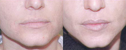male chin augmentation results