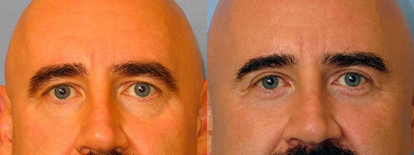 male blepharoplasty results