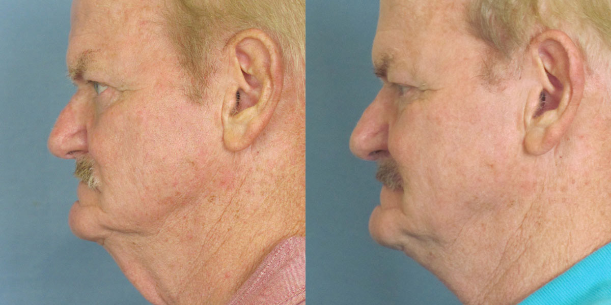 male neck lift results