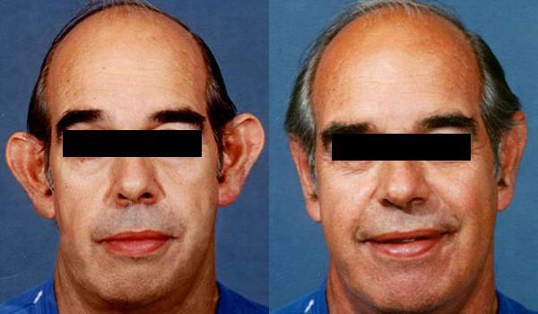 male ear surgery results