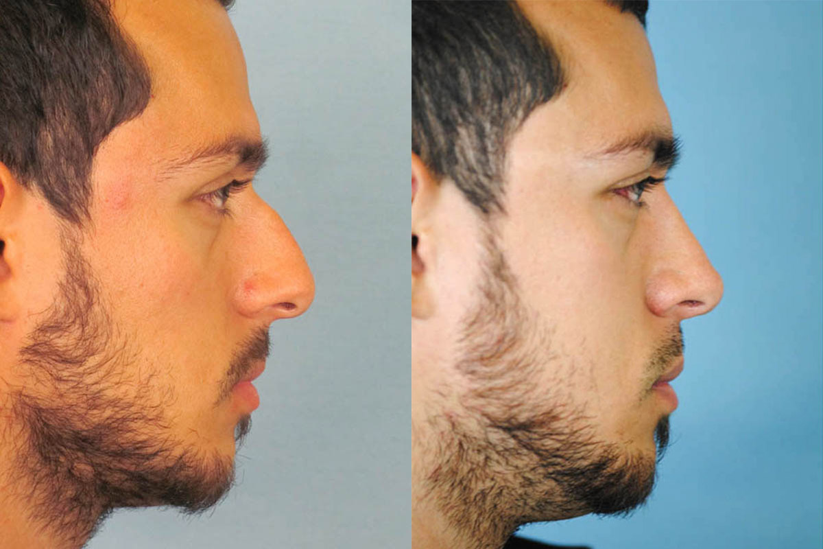male rhinoplasty results